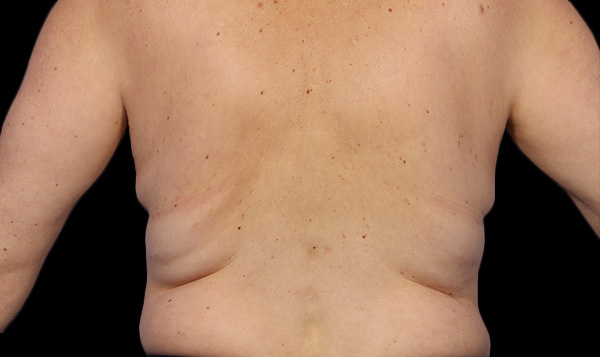 Before coolsculpting flanks